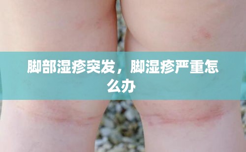 腳部濕疹突發(fā)，腳濕疹嚴(yán)重怎么辦 